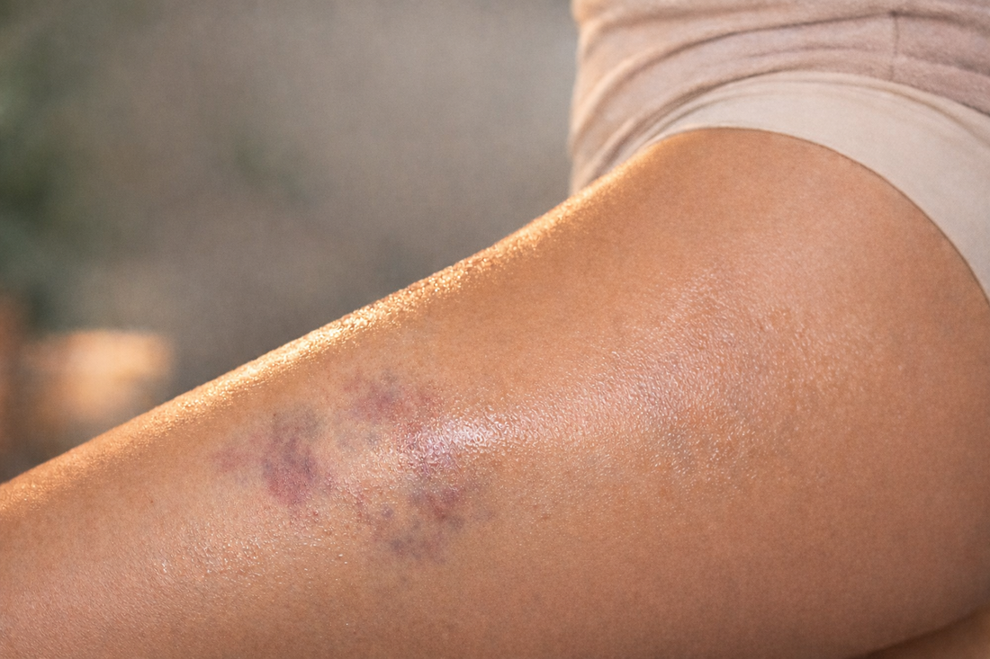 Blå mærker og ømhed efter vakuum-massage: Er det normalt, og hvordan undgår du det?
